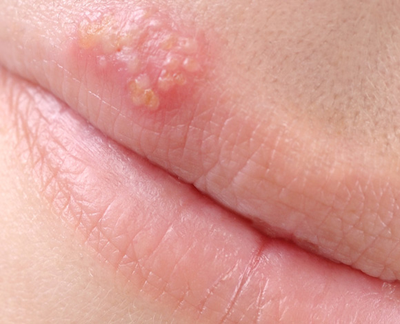 Oral Herpes